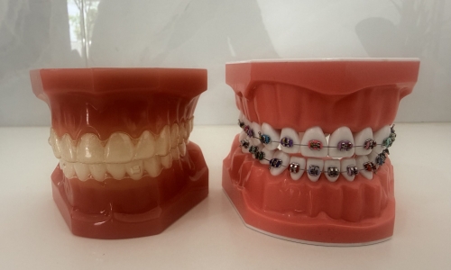 Invisalign vs Braces for Kids