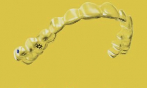 Invisalign Invisalign